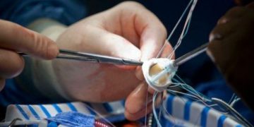 а клапана сердца в Германии: преимущества заграничной медицины