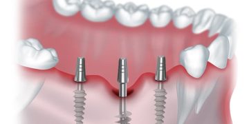 Виды имплантации зубов в клиниках: как они вернут красоту улыбки