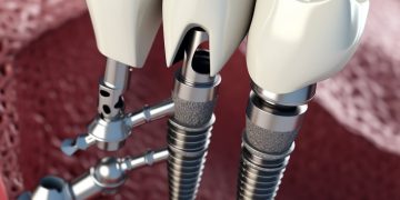 Имплантация зубов: современные технологии и преимущества для пациентов в стоматологии