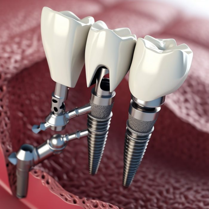 Имплантация зубов: современные технологии и преимущества для пациентов в стоматологии