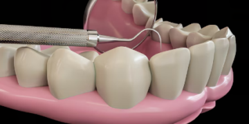 Возвращение улыбки: как имплантация зубов меняет жизнь